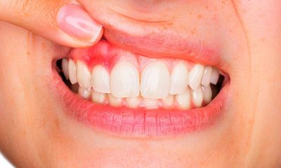 Research Links Heart Problems and Other Serious Health Conditions to Gum Disease 